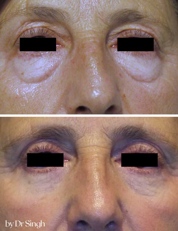 before after blepharoplasty nyc